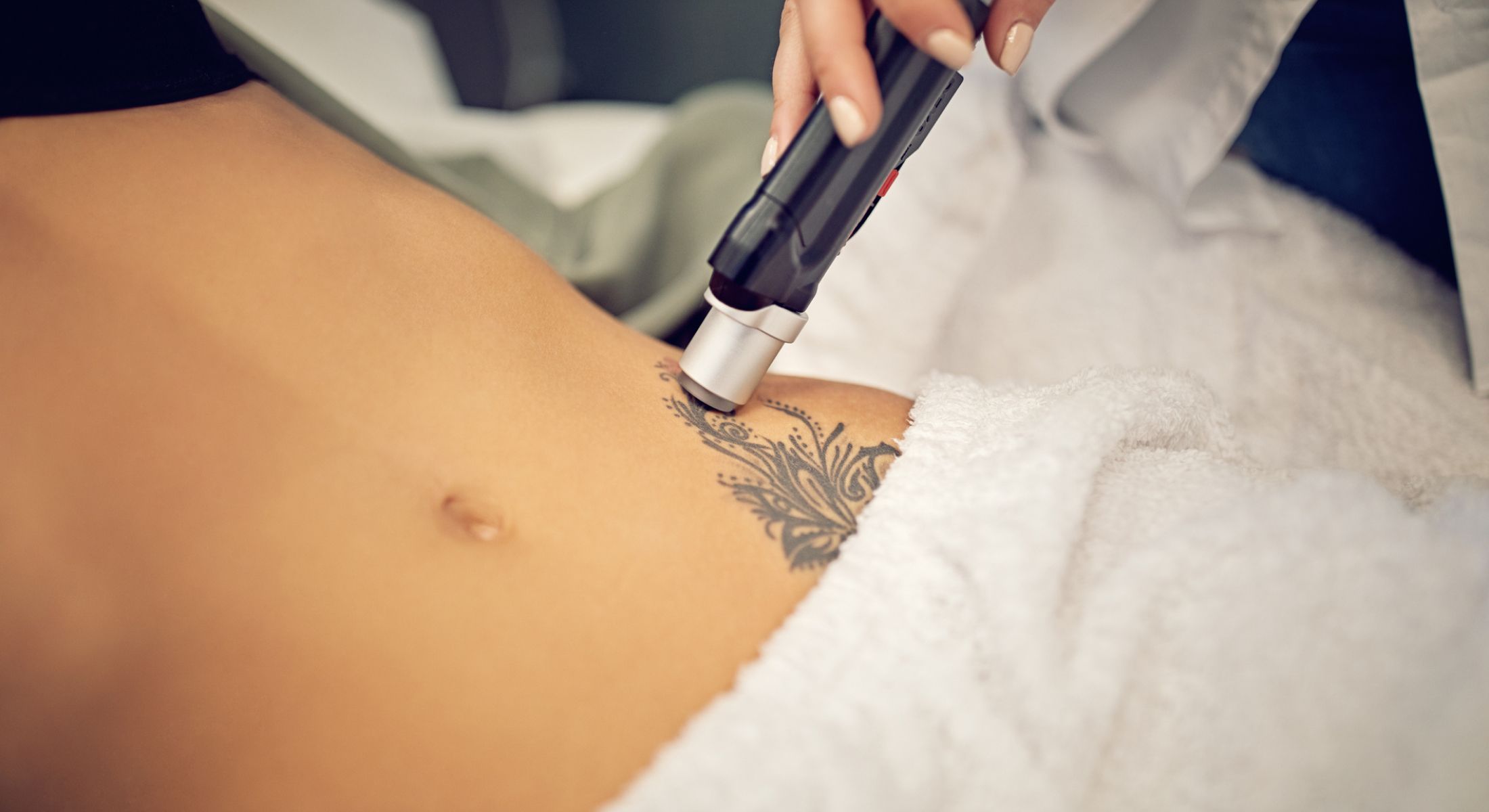 laser tattoo removal patient model receiving treatment on her abdomen